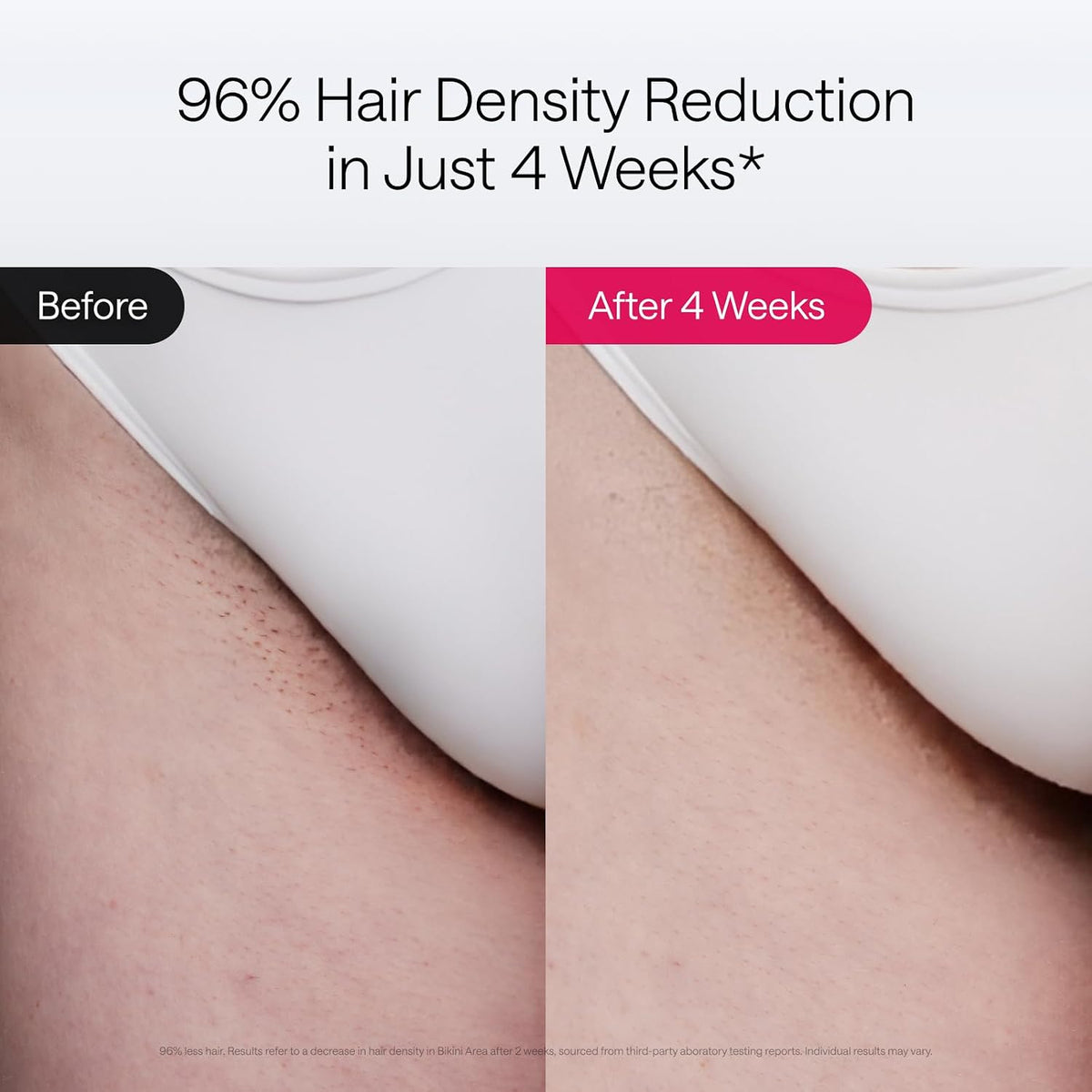 Ulike Laser Hair Removal Air 10 Deluxe Version IPL for for Women and Men with Ice-Cooling Technology, Nealy Painless and Permanent Hair Reduction, at Home Hair Removal in 10mins with Skin Sensor